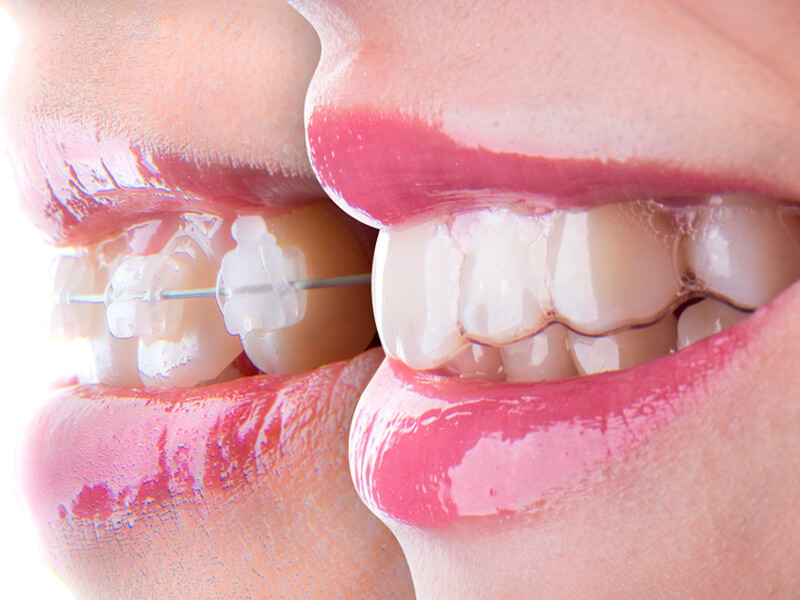 Invisalign - Campo Grande - MS