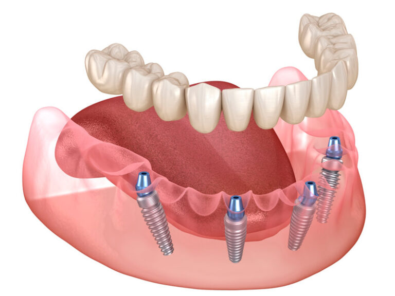 Protese Control Plate Clínica de Prótese Protocolo - Campo Grande - MS